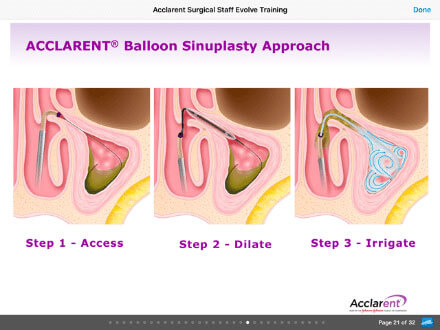 balloon sinuplasty info pic