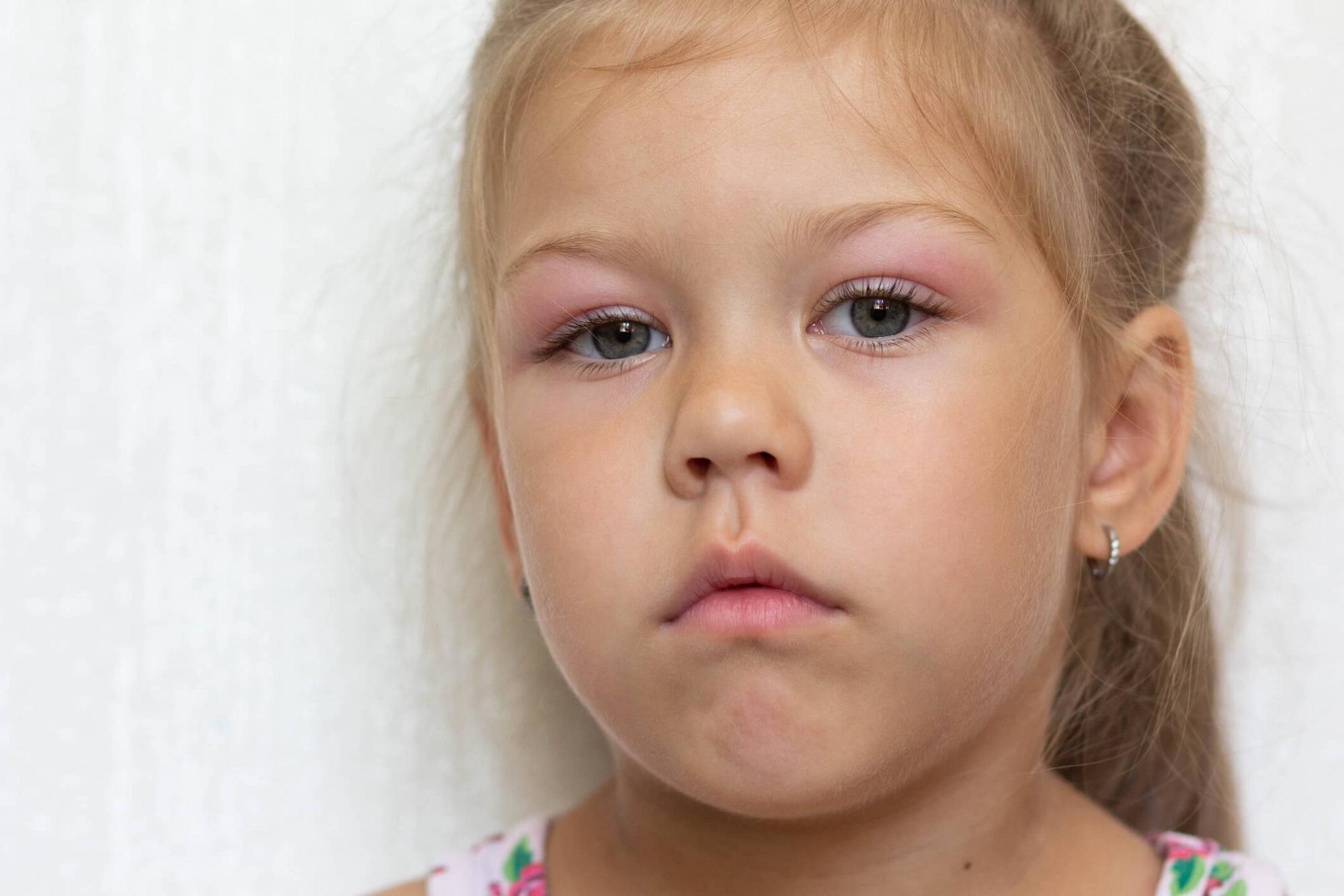 Swollen Adenoids in Kids